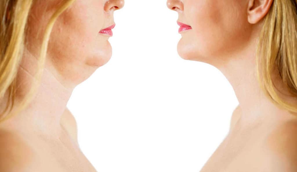 Double Chin treatment Hampshire before and after results