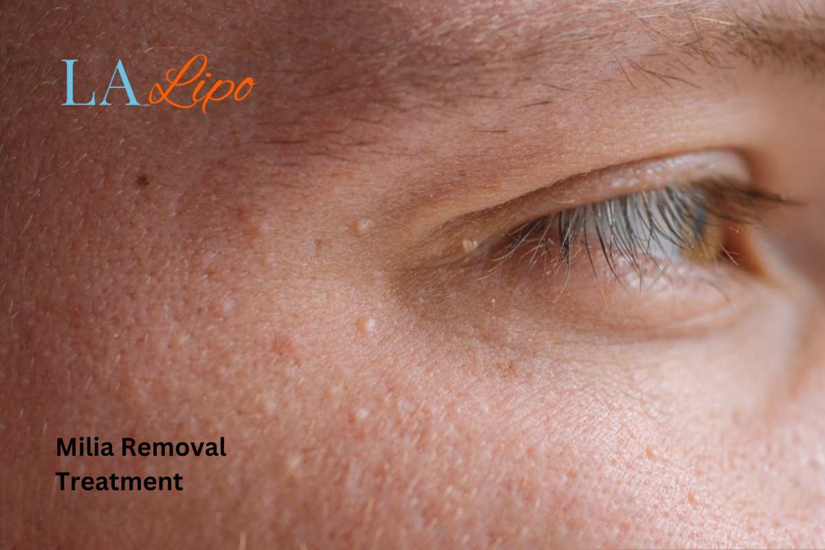 Cryopen Milia Removal: Is It the Easiest and Safest Option Hampshire?