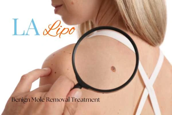 Why getting moles removed Hampshire can boost your confidence!