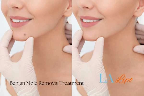 woman's before and after mole removal Hampshire results