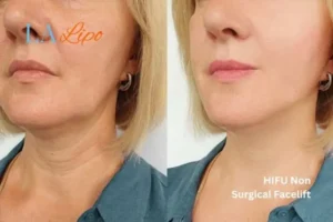 hi-fu for wrinkles Hampshire before and after results
