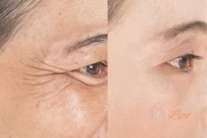 Before and after results of woman - HI-fu wrinkles reduction treatment Hampshire