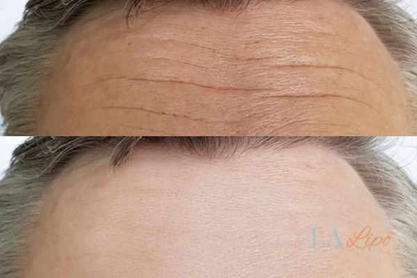 results of HIFU Hampshire on mans forehead to help reduce lines and wrinkles