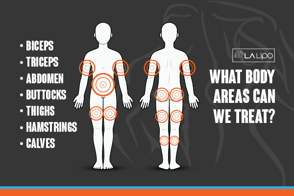 Graphic to show areas you can have LA-EMS Body Sculpting Hampshire treatment.