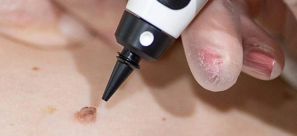 skin tag removal using cryopen Hampshire