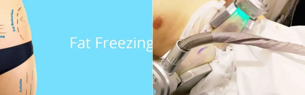 Fat freezing Hampshire on multiple areas of the body
