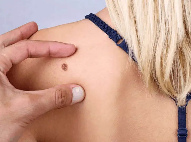 woman having mole removal Hampshire consultation before treatment.
