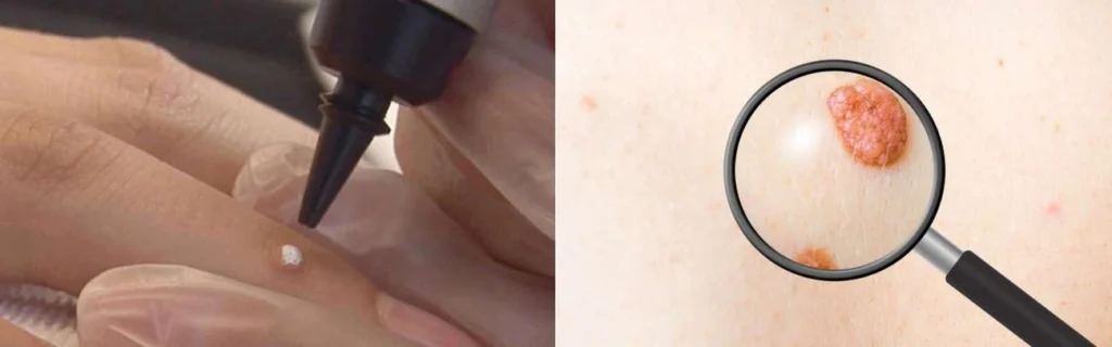 Person getting moles removed with cryopen Hampshire