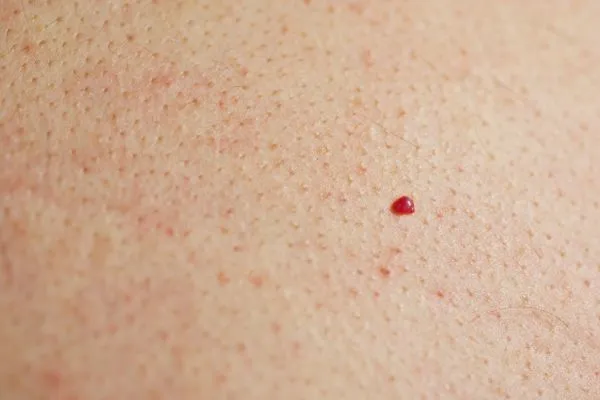 close up of a cherry angioma Hampshire