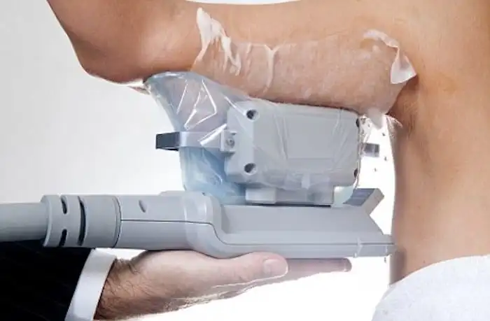 Picture of fat freezing Hampshire on the upper arms.
