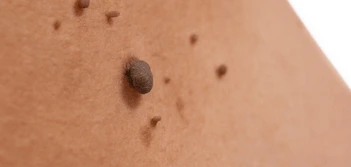 image of a skin tag Hampshire