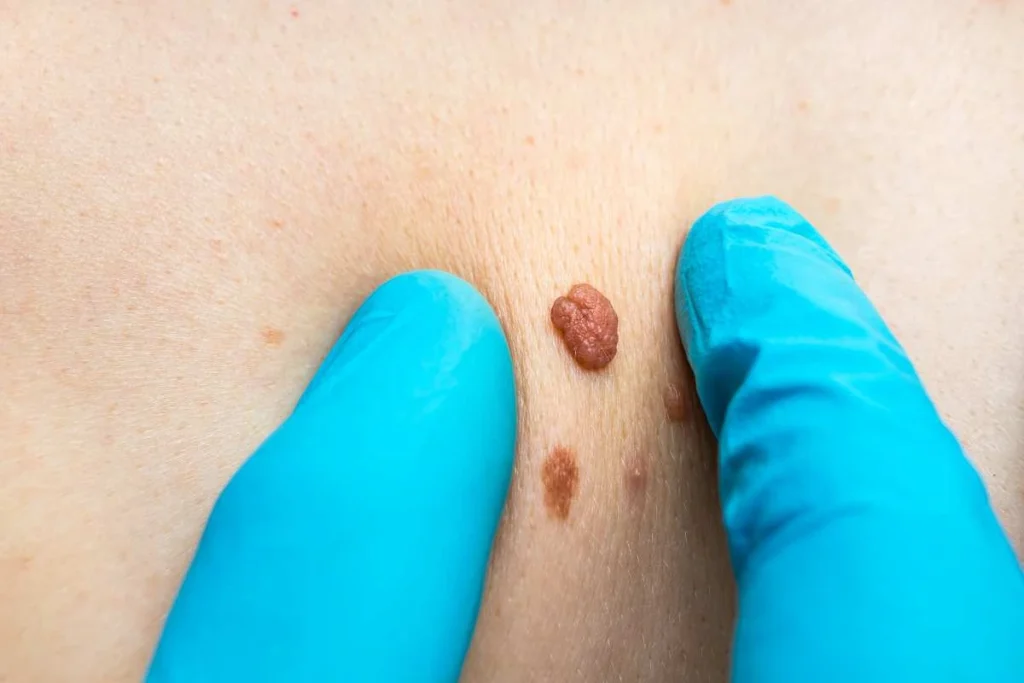 Consultant examining a skin tag Hampshire