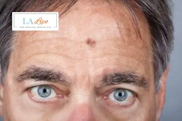 Solar Lentigo Removal Hampshire image of man with mark on his forehead