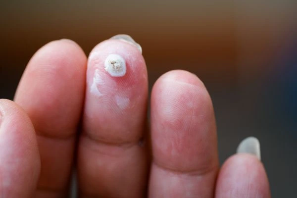 wart on person finger - cryotherapy to treat from LA LIPO Hampshire