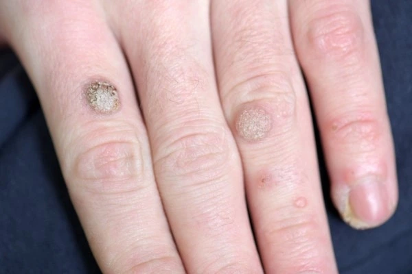 photo of warts on person hand - see wart removal Hampshire from LA LIPO