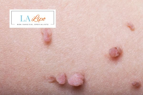 Does cryopen skin tag removal Hampshire hurt? Find out now call our team today!