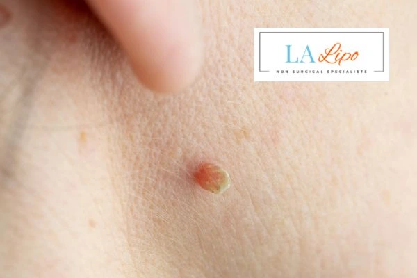 Book skin tag removal Hampshire today speak to our team now!