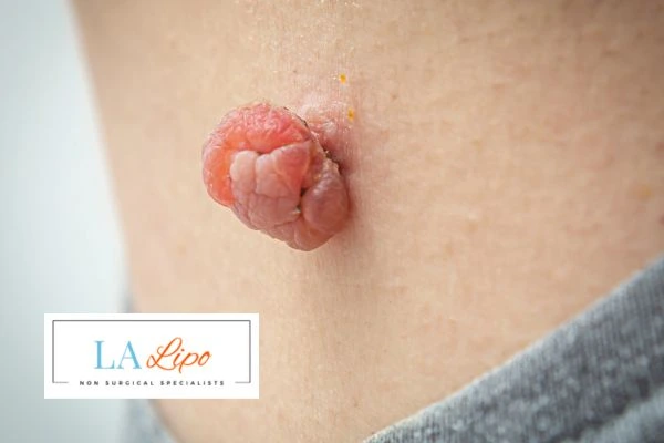 Interested in skin tag removal Hampshire? Concerned about the pain? Find out more today!