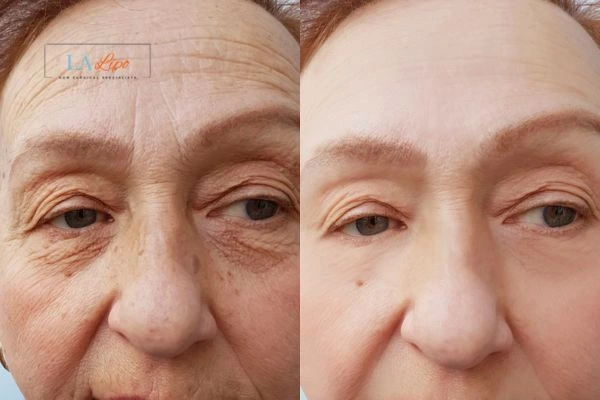 The powerful benefits of Morpheus8 Treatment Hampshire - Call Our team today!