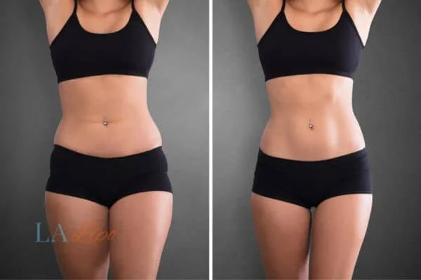 before and after results of non-surgical treatment to help a woman's body image and mental health Hampshire