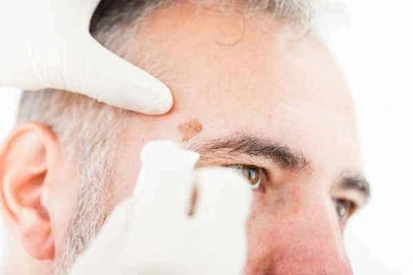 Age spots and elderly people Hampshire what is the link?
