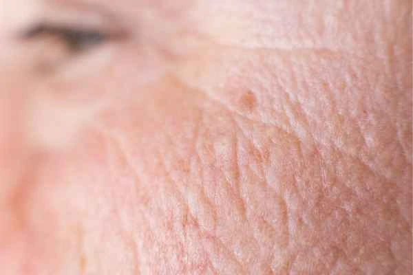 close up picture of a woman's face showing an age spot Hampshire