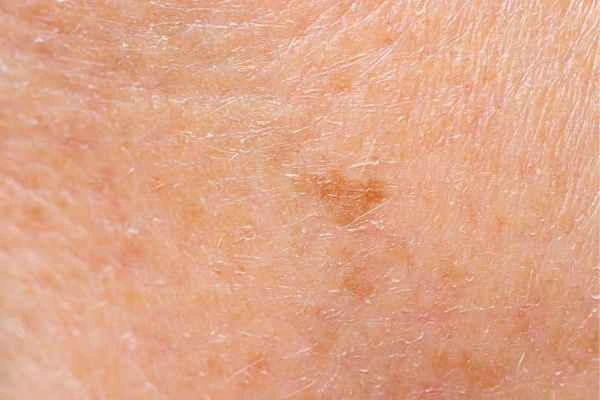 close up picture of age spots Hampshire