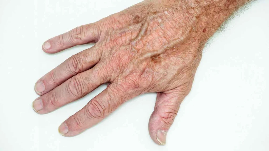 Male hand showing age spot Hampshire