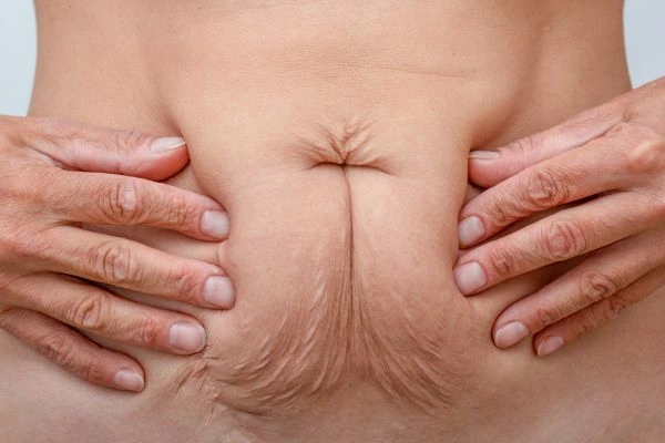 Should I Combine Diastasis Recti Treatment with Body Contouring for Better Results Hampshire?