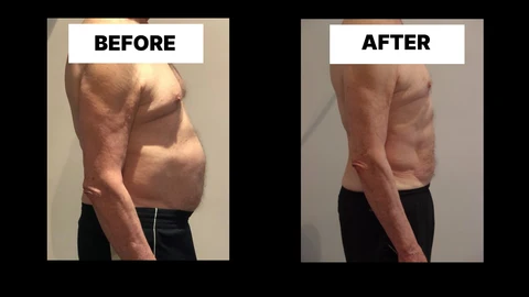 What Symptoms Can Diastasis Recti Cause in Men? Weak Core, Back Pain and Poor Posture Hampshire